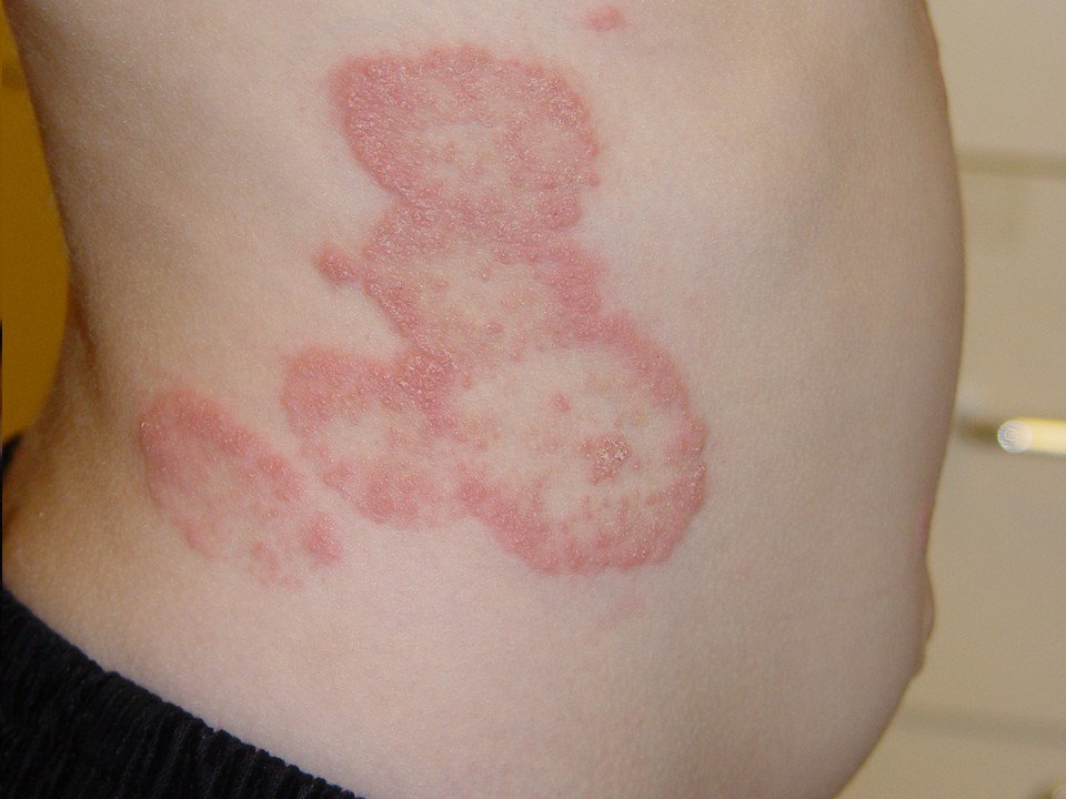 What Do You Treat Ringworm With Dog What Do You Treat Ringworm With Dog